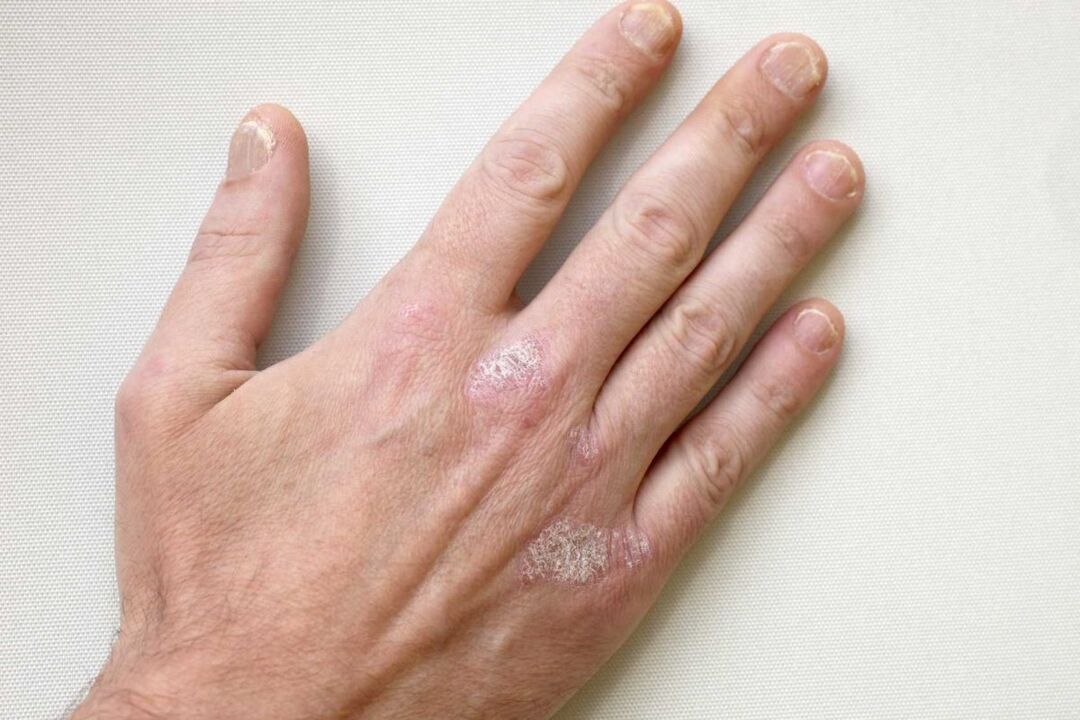 Psoriasis an den Händen eines Mannes Behandlung mit Keramin-Creme