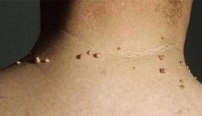 Die Gründe für das Auftreten von Papillomen am menschlichen Körper