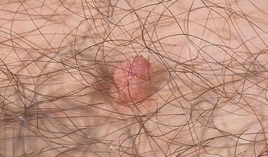 Möglichkeiten, das menschliche Papillomvirus zu übertragen