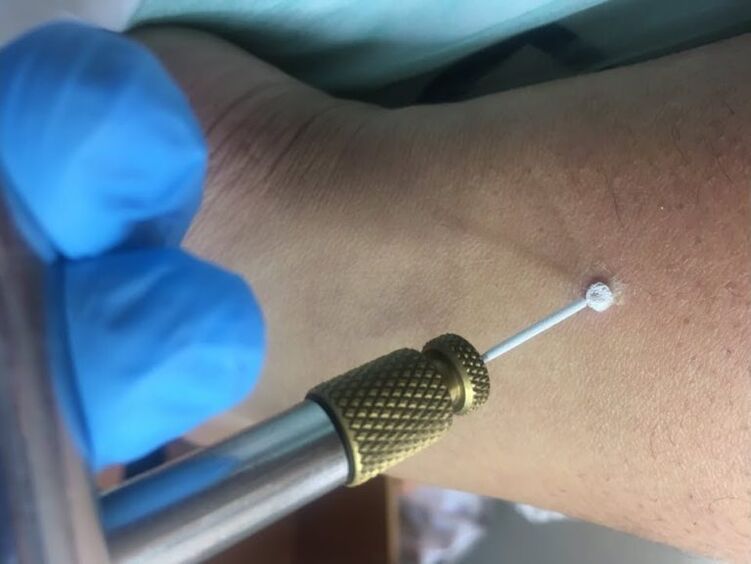 Möglichkeiten, Warzen zu entfernen