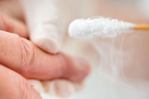 Behandlung von Warzen mit flüssigem Stickstoff