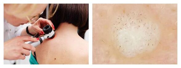 Dermatoskopie der Warze