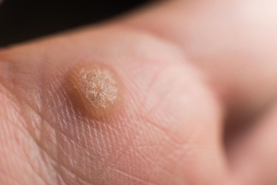 Humanes Papillomavirus auf der Haut