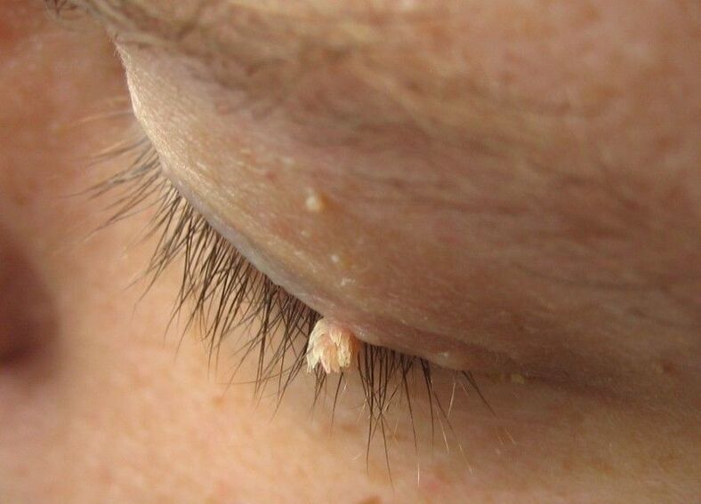 Warzen vor unseren Augen