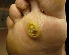 Subanary Papillome